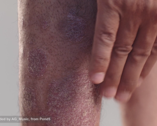 camp-lejeune-scleroderma-video-img