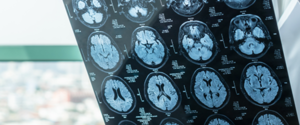 traumatic brain injury